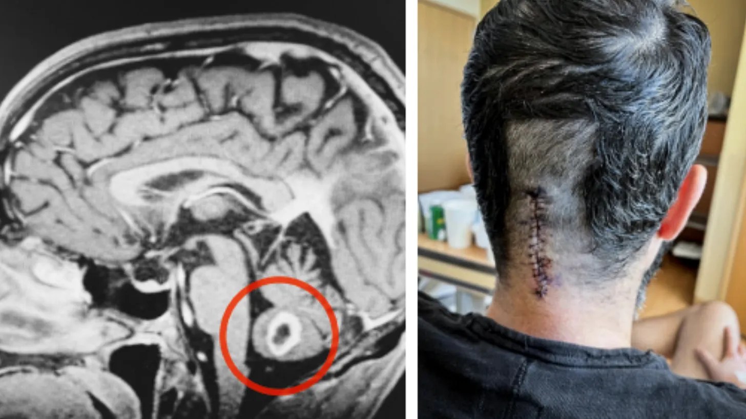 A brain MRI scan with the lesion circled, beside a photo of the surgical scar on the back of Eric Markowitz’s head